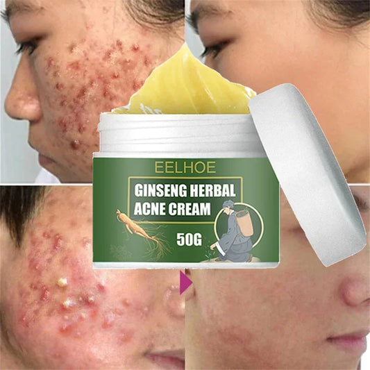 Ginseng Herb Acne Removal Cream Treatment Pimple Scar Spots Shrink Pores Oil Control Whitening Moisturize Face Acne Skin Care
