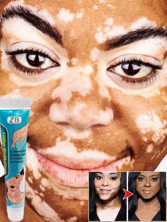 20g ZB Herbal Extract Vitiligo Ointment Remove Ringworm White Spot Removal Skin White Spot Leukoplakia Disease Treatment Cream