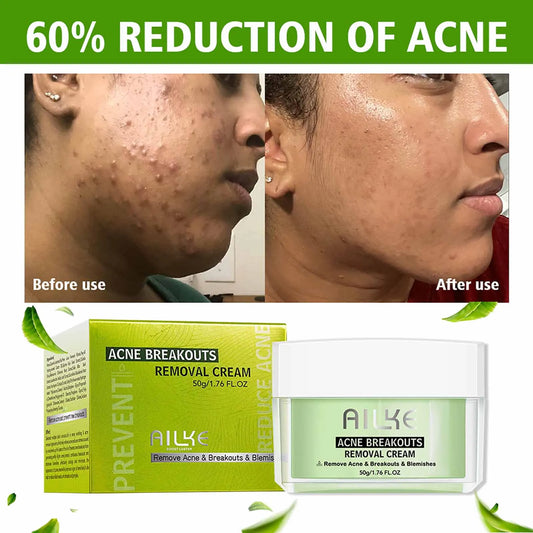 AILKE Acne Removal Face Cream, Reduce Pimples & Breakouts Facial Cream, Deeply Clean Skin, For All Skin Types, For Women, Men
