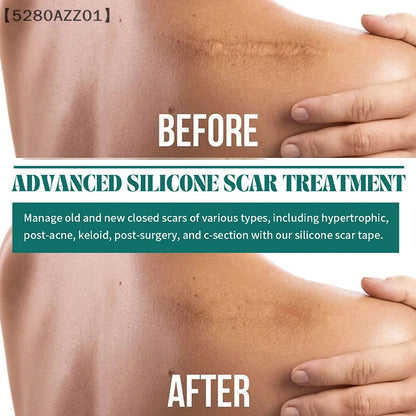 1 Roll Silicone Scar Sheets Gel Scar Patch 4cmX150cm Self-Adhesive Scar Cover Tape Reusable And Effective Skin Care Strips