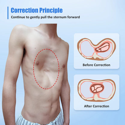 Pectus Excavatum Orthosis Brace, Sternal Depression Support, Thoracic Depression Brace Sunken Sternum Brace for Adults and Child