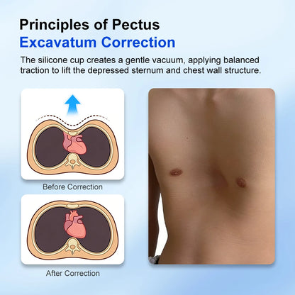Pectus Excavatum Vacuum Bell with Automatic Pump Pectus Excavatum Orthosis Brace for Sunken Chest Thoracic Depression Support
